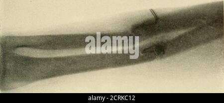 . Röntgen diagnostic et thérapie de la radiographie . Figure 150.—fracture déplacée de Radius et d'Ulna, produisant une synosose. Les fragments inférieurs de l'ulna et les fragments supérieurs du rayon, qui à eux seuls excluraient toute possibilité de rotation(Fig. 150). ÉPAULE ET MEMBRE SUPÉRIEUR 213 tout d'abord, on a tenté de corriger la position des fracturations de l'avant-bras droit, en les exposant et en les libérant.sous la direction du skiagraph, une incision semi-lunaire dans un. Fig. 151.—cas illustré à la Fig. 150, après le câblage. La direction oblique a été faite. Le raccourcissement a été surmonté par le recours à des extensi forcé Banque D'Images