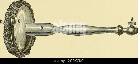 . Les utilisations médicales et chirurgicales de l'électricité : y compris les rayons X, la lumière de Finsen, les traitements vibratoires, et les courants à haute fréquence . Figure 80,—poignée universelle. Figure 81.—attacher le fermoir et la poignée avec l'éponge (Kidder). Banque D'Images