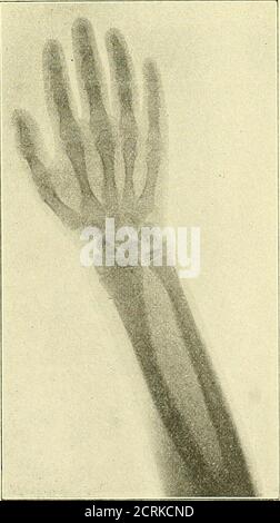 . Klinische und Anatomie Untersuchungen über den Cretinismus . Figure 45.. Radiologische Untersuchungen.FiO;. 46. 183 Banque D'Images