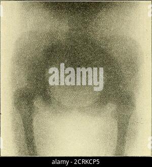 . Klinische und Anatomie Untersuchungen über den Cretinismus . 182 Iladiologiche Untersuchungen.Fig. 44.. Figure 45. Banque D'Images