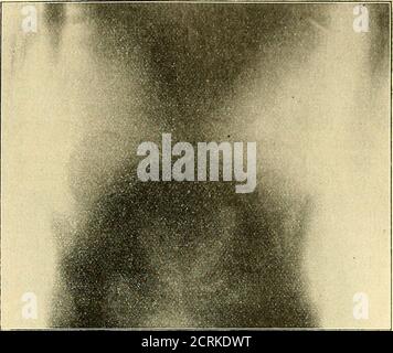 . Betrieb einer Bürgen. Der Beckeneingang ist asymétrich. Dierechte Beckenhälfte ist kleiner. DAS Kreuzbein springt gegen dasBecken vor^ ebenso, jedoch nur wenig angedeutet, die Pfannengegend, Radioiogische Untersuchungen.Fig. 37. 177. Figure 38. Banque D'Images