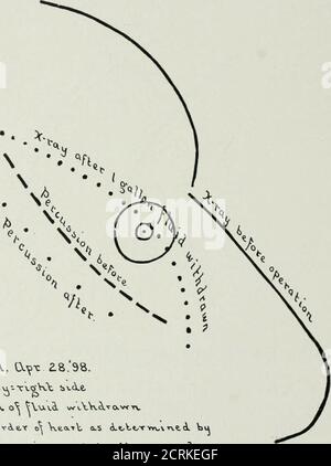 . Le Roentgen rayons en médecine et en chirurgie comme aide au diagnostic et comme agent thérapeutique; conçu pour l'usage des praticiens et des étudiants . t Borderof Heart; ligne brisée, sa position telle que déterminée par percussion. (Couper un tiers de la durée de vie.) Si, par un examen radiologique, nous iind chez n'importe quel patient (à l'exclusion des maladies acutémiques) un coeur élargi, nous devrions considérer parmi les probablections la présence de lésions valvulaires, artériosclérose (en particulier l'âge moyen et après), maladie rénale, et emphysème des poumons; la condition thislast serait très évidente par un examen radiologique. SECTION IV DISP Banque D'Images