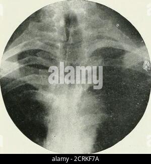 . Archives de la médecine physique et de la réadaptation . hin,petit, et dirigé obliquement vers le haut.deux processus transversaux sont venus du côté gauche de la vertèbre; le bas était petit et incurvé. L'alade droite du sacrum était de taille normale, alors que l'alade gauche était inférieure à la moitié de la norma!size. Le bassin a été incliné à com-pensate pour le calage de la cinquième vertèbre lombaire. Pendant dix ans, le patient avait souffert de maux de dos plus ou moins constants, avec des douleurs tendus entre les hanches et à la pointe de l'ihe coccyx en essayant de se lever. Cas 8 (A263178). Congénitalanomalie du sacrum chez un garçon aged1 Banque D'Images