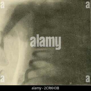 . Röntgen diagnostic et thérapie de la radiographie . Figure 128.—ankylose fibreuse de Souldeb. 129 illustre la fracture de la diaphyse chez un enfant nouveau-né.bien que l'exposition ait duré seulement quelques secondes, la ligne de fracture et le déplacement angulaire ainsi que le déplacement axial des fragmentssont bien représentés. L'objectif du tube étant situé à droite 186 LE RONTGEN EAYS au-dessus de l'humérus, il est apprécié pourquoi cette zone semble claire, tandis que les autres zones montrent une teinte plus foncée. En ce qui concerne la dislocation, on suppose généralement que dans le type frequentsubcoracoid, l'aplatissement de l'épaule, le changement axial,. Banque D'Images