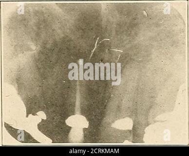 . Interprétation des roentogrammes dentaires et maxillaires . Figure 214. Fig. 215. Banque D'Images