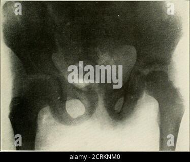 . Roentgen interprétation; un manuel pour les étudiants et les praticiens . Figure S3.—dessiccateurs Osteondrtis.. Figure 84.—maladie de Perthes. Un cas précoce. Noter la légère déformation de la tête des ARTICULATIONS du fémur, DES TENDONS ET du BURSM Banque D'Images