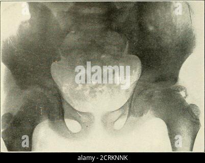 . Roentgen interprétation; un manuel pour les étudiants et les praticiens . Figure 84.—maladie de Perthes. Un cas précoce. Noter la légère déformation de la tête des ARTICULATIONS du fémur, DES TENDONS ET du BURSM. Figure 85. -maladie de Perthes. Le même cas que celui de la Fig. 84, un an plus tard, est maintenant bien marqué et assez typique. Le processus Banque D'Images