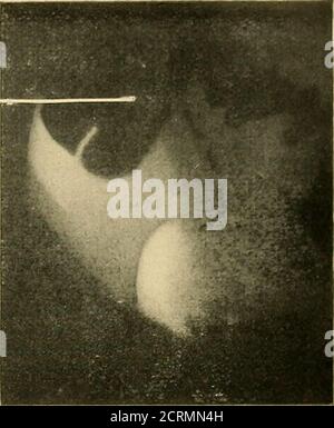 . Le tube digestif : une étude radiographique . Figure 64. Fig. 65. Banque D'Images