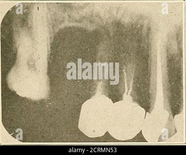 . Interprétation des roentogrammes dentaires et maxillaires . Figure 22.-C.. Banque D'Images
