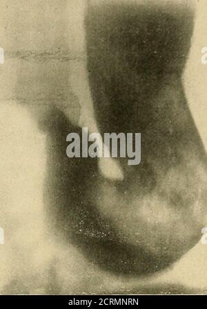 . Le tube digestif : une étude radiographique . Figure 54- Fig. 55- Banque D'Images