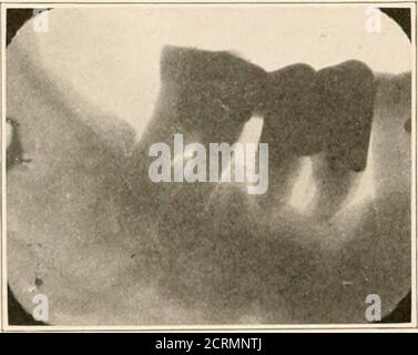 . Sepsis oral dans sa relation à la maladie systémique . Figure 11. Fig. 12.. Banque D'Images