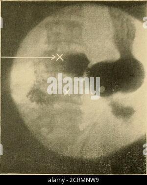 . Le tube digestif : une étude radiographique . Fig. 58. Fig. 59 Banque D'Images