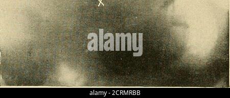 . Le tube digestif : une étude radiographique . Figure 42 Banque D'Images