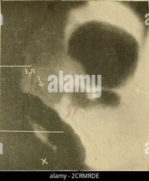 . Le tube digestif : une étude radiographique . Figure 46. Fig. 47- Banque D'Images