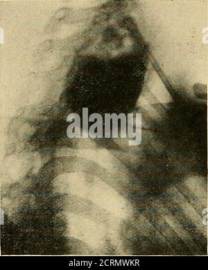 . Le tube digestif : une étude radiographique . Fig., ii. Fig. :. 12.. Banque D'Images