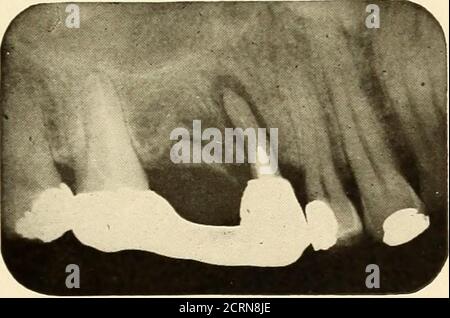 . Roentgoenologie orale : étude de Roentgen sur l'anatomie et la pathologie de la cavité buccale . Figure 289. Figure 290. Banque D'Images