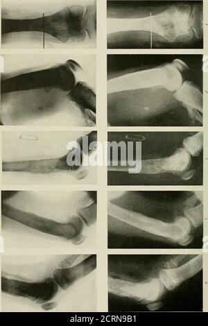 . Radiographie et radiothérapeutique . PLAQUE XXXVI.—fractures de la jambe, de la cheville et du pied. A, fracture oblique de l'arbre du tibia, vue latérale, montre des épiphyses de l'extrémité inférieure du tibia et aussi des ofos calcis. h, vue antéro-postérieure du tibia et du péroné, montrant une fracture oblique de l'arbre du tibia ; Et alsoepiphyses à l'extrémité inférieure du tibia, du péroné et de l'os calcis. c, fracture par l'arbre du fémur ; l'os est raréfié et est probablement le siège du carcinome secondaire. d, fracture de l'extrémité inférieure du tibia et du péroné, dislocation avant du tibia. e, fractures du tibia et du péroné ; noter la nature de la fracture Banque D'Images