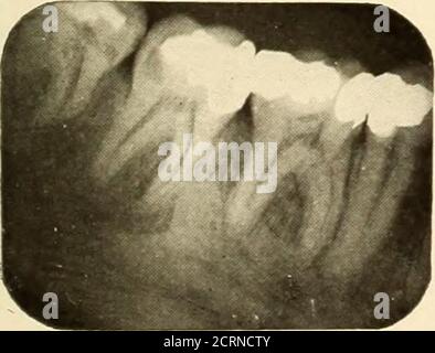 . Roentgoenologie orale : étude de Roentgen sur l'anatomie et la pathologie de la cavité buccale . Figure 107.. Banque D'Images