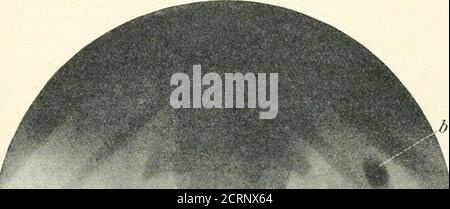 . Radiographie, thérapies à rayons X et radiothérapie . tance de ce type, où un grand fard i^Isen^dans le bassin du rein, qui pourrait facilement avoir été diagnostiqué comme une grande pierre. Une deuxième radiographie, prise deux jours plus tard après la purge sans fin, montre la masse plus basse dans le côlon. Le point qui a donné lieu à un diagnostic de f secalmatière était la condition de charge du colonover de la région Kid-ney opposée. (2) la bodiesin étrangère dans l'intestin peut être confondue avec cal-culus. (3) les mésentéricines androcalcifiées sont des antherelement conduisant à la toerreur dans le diagnostic de l'urinarydiagnostic. (4) le cas de bo étranger Banque D'Images