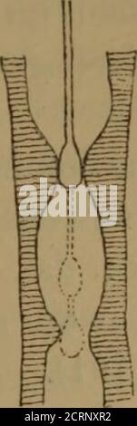 . inneren Krankheiten auf Grund der heutigen Untersuchungsmethoden : ein Lehrbuch für Aerzte und studierende . Figure 101. Schematische Darstellung der Sondirung BEI einer kurzen, einer längeren, einer doppelten Stenose. Banque D'Images