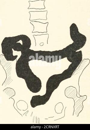 . Radiographie, traitements par rayons X et radiothérapie . l'iltation et les taches dans l'intestin grêle. Diagnostic : adhérences dans le voisinage de la valve iléocaecale. Examen du gros intestin le gros intestin est divisé en (1) caecum ; (2) côlon ascendant ; (3)flexion hépatique ; (4) côlon transverse ; (5) flexion splénique ; (6) côlon descendant ; (7) flexion sigmoïde ; (8) rectum. Les relations anatomiques des parties doivent être clairement comprises. Le caecum est la partie du côlon qui se trouve sous la valve iléocaecalvalve. Il est presque entièrement entouré par le péritoine, et, étant indépendant ymov Banque D'Images