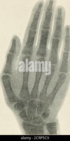 . Radiographie, thérapeutique à rayons X et radiothérapie . Figure 121.—main d'un enfant de plus de cinq ans. Montre le développement des os des extrémités inférieures du rayon et du cubitus, des bonts carpiens, des métacarpals, des andphalanges. L'épiphyse de l'extrémité inférieure du radiuswell s'est développée. L'épiphyse ulnaire n'est pas apparue. Les os magnum et unciforme, semi-lunaire et cuneiforme sont également illustrés. Thepisiform n'est pas affiché. Noter également le centre avant l'extrémité proximale de l'os métacarpien du pouce. Les épiphyses des quatre os métacarpiens intérieurs sont vus aux extrémités des puits, mais dans les phalanges et dans le mét Banque D'Images