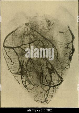 . Les rayons de Röntgen dans le travail médical . g des conclusions quant à la normale vasculaire supplypeuvent être citées. Ainsi, il a été trouvé que la circulation dans le rein est lobar et terminal, et permet la différenciation du rein antérieur et postérieur indépendant, sauf l'artère du lobe supérieur, qui se divise souvent en deux branches, de sorte que, lorsqu'il est injecté, la partie supérieure entière est perméée. ProfessorDawson Turner a gentiment autorisé une reproduction de photographies d'un rein et d'un coeur humains injectés (figues. 170 et 171), preparedpar l'injection lente d'une préparation ordinaire en salle de dissection Banque D'Images