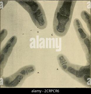 . Le Röntgen rayons dans le travail médical . Figure 127.—M. Cas de réévesse du membre supérieur gauche déformé, excroissances de Bony d'Humerus et carence de coude-joint et Bones d'avant-bras. Côté droit illustré sur la Fig. 123. Dr Walsh. Reproduit à la figure 128 montre un os en forme de coin supplémentaire entre la première et la partie terminale des phalanges du pouce. The End * Scottish Med. Et Surg. Journal, septembre 1901, p. 198. APPLICATIONS MÉDICALES ET CHIRURGICALES 255 phalanges étaient bifides. Il y avait une histoire familiale de orteils supplémentaires de digitsand, et le pouce large et les grands-orteils, et aussi de la sangle.les pouces de pères n'étaient pas bifides Banque D'Images
