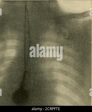 . Le Röntgen rayons dans le travail médical . Figure 80.—Watch and Chain In (oesophage, avalé par OstrichMan {American X-Pay Journal, juillet 1898). Les corps étrangers peuvent être facilement détectés dans les estomacs des enfants, et parfois dans ceux des adultes. Ainsi, le Dr Scott, du Kansas, a publié le cas intéressant suivant, accompagné d'une photo Rontgenphotographie : radiographie de l'abdomen de l'autruche-homme, M. G. W. Whallen, prise par le Dr. E. Von Quast. La masse sombre sur le côté gauche de l'image contieus116 différentes pièces de métal et une poignée de verre. Patient opéré le 8 juin 1897 à l'hôpital allemand. Banque D'Images