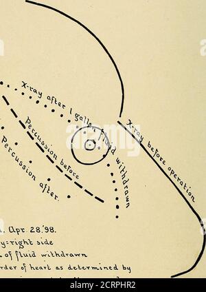 . Le Roentgen rayons en médecine et chirurgie comme aide au diagnostic et comme agent thérapeutique : conçu pour l'usage des praticiens et des étudiants . Borderof Heart; ligne brisée, sa position déterminée par percussion. (Couper un tiers de la durée de vie.) Si, par un examen radiologique, nous trouvons chez un patient (à l'exclusion des maladies acutémiques) un coeur élargi, nous devrions considérer, parmi les probablecies, la présence de lésions valvulaires, artériosclérose (en particulier l'âge moyen et après), maladie rénale, et emphysème des poumons; la condition thislast serait très évidente par un examen radiologique. SECTION IV DISPL Banque D'Images