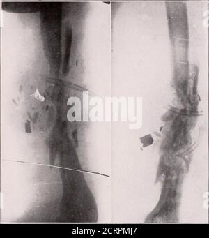 . Journal of roentgoenologie . fragments d'os détachés et par-tially desserrés qui sont irréguliers distribués dans les tissus du tiers médian du bras. Une distance de trois pouces et demi est intervenue entre la partie proximale et distale de l'arbre de l'humérosse qui n'a pas été fracturée. Cet espace intermédiaire a été fillésé par les fragments d'os desserrés, comme le montre le soi-ray.de nombreuses particules de métal peuvent être observées distribuées dans les tissus thétraumatisés. L'extension a été maintenue par une attelle Thomas modi-fied pour les fractures de l'humérus. L'irrigation de CarrelDakin a été effectuée. Figure Banque D'Images