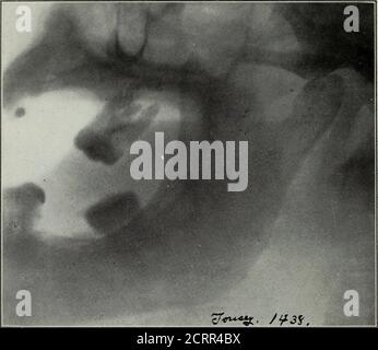 . Radiographie élémentaire et dentaire . Figure 281. Les flèches de Tiie pointent vers une fracture de la mâchoire inférieure juste derrière le second bicus-pid. Le côté oi)posite de la même mâchoire, radiée sur la Fig. 280. (Radiographie par Cole et Raper.) 244 RADIOGRAPHIE DENTAIRE. Figure 282. Excellente radiographie de l'articulation temporo-inandibulaire. Fabriqué à partir d'un livinjSubject. (Radiographie de Tousey, de New York.) Cas: Dislocation de la condyle des Tigs. 2$3 et 2$4. fosse aux glénoïdes. Figure 283 montre la condyle A antérieure à l'éminentia articilaris B. Fig. 284 de ce cas après réduction. Lorsqu'il échoue t Banque D'Images