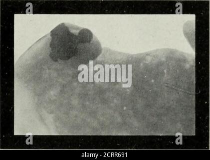 . Radiographie élémentaire et dentaire . l'os dans certaines parties.de cette apparence, avec le léger élargissement des glandes,,le cas a été diagnostiqué comme myélosarcome. Un examen microscopique du tissu enlevé, a confirmé le diagnostic. Je ne reproduis pas la radiographie de l'autre cas parce que l'original que j'ai n'est pas assez clair pour permettre une bonne reproduction de demi-teinte. L'imprimé devant moi montre assez bien trois dents inférieures affectées, l'une un bicuspide rudi-mentaire, les autres un deuxième et troisième molaire. LES UTILISATIONS OP LA RADIOGRAPHIE EN DENTISTERIE 227 le Dr Cryer dit: Il semble y en avoir Banque D'Images