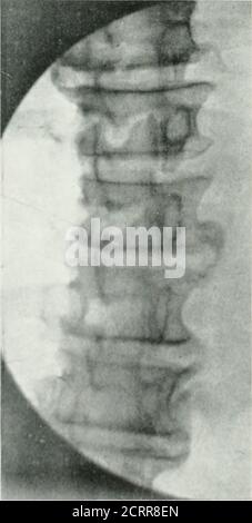 . Archives de médecine physique et de réadaptation . arthrite tuberculeuse, arthri-tis syphilitique, arthrite gonorrhéale et goutte. La polyarthrite rhumatoïde est une affection des membranes synoviales et des tissus thesoft au niveau des articulations, et donc généralement susceptible de démonstration sur le film radiographique. Il a, comme arule, un début aigu et orageux, se produit des sujets plus jeunes, et simultanément affecte de nombreuses articulations, principalement les petits. L'OSTEO-arthrite est principalement une disasedu cartilage et des os, tendant à la destruction du cartilage, et à la thélormation de la croissance ostéophytique aarticulaire Banque D'Images