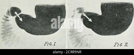 . Archives de médecine physique et de réadaptation . il duodénombre est resté vide pendant la demi-heure suivante. Quelques jours plus tard, ce garçon a développé une jaunisse, qui a été traitée par un traitement médical. Dans cette con-nection il est bon de se rappeler Alvarezwarning que comme la présence de la bilein l'estomac est normal, n'importe quelle excessneed pas indiquer la maladie de la liverso autant qu'une augmentation de la régurgitation normalduodénale. L'absence de régurgitation est es-perceptible dans les cas de diseasedgall-vessie où l'on expectpour le trouver selon les patients com-plain, et où les cliniciens principaux Banque D'Images