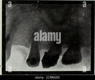 . Radiographie primaire et dentaire . al Dans ce cas, la radiographie a enregistré un travail considérable et s'inquiète de la part de l'opérateur. J'ai le deuxième et le troisième molaires pour avoir seulement un canal mais c'est le seul casei jamais rencontré dans lequel un premier molaire avait un seul canal. Ce cas était entre les mains de l'un des plus TIG. 167. Opérateurs experts à Indianapolis. La première bicuspide inférieure avait été dévitalisée, et la pulpe retirée, 1/4 RADIOGRAPHIE DENTAIRE) mais la dent demeurait douloureuse. La radiographie a eu recours pour apprendre, ifpossible, la cause de la péricementite persistante. Un morceau de li Banque D'Images