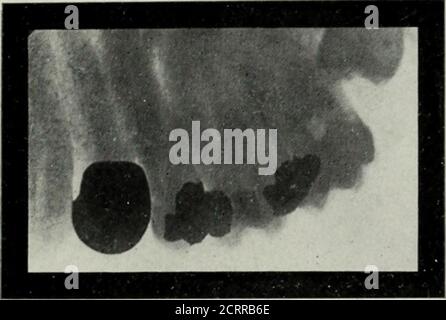 . Radiographie élémentaire et dentaire . Figure 159. Molaire supérieur et inférieur touché. Absorption de la racine distale de la molaire inférieure seconde. (Radiographie de Pancoast, de Philadelphie.) difficulté de fonctionnement par rapport aux autres opérations. Le removaldu troisième molaire, illustré sur la Fig. 162, est une opération plus difficile que la theremoval d'une annexe vermiforme. En montrant aux patients des radiographies de tels cas le dentiste gagnera leur sérieux, la coopération intelligente.ils sauront juste ce qui est fait pour eux, et pour la première fois dans leurs UTILISATIONS OP LA RADIOGRAPHIE IX DENTISTERIE 171 vies Banque D'Images