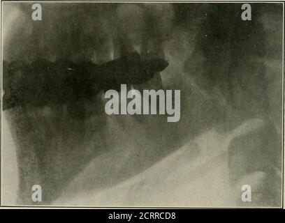 . Radiographie élémentaire et dentaire . Figure 28r,. Fracture à l'angle de la mandibule. Déplacement de l'endsgra fracturé; h par Pancoast, de Philadelphie.) (Radio-. Figure 280 aftr i « «l»i&lt;-ti.»ii anrl adjuMin. nl (radiographie de Pancoast, de Philadelphie.) attelle dentaire. LES UTILISATIONS DE LA RADIOGRAPHIE EN DENTISTERIE 249 Banque D'Images