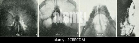 . Archives de médecine physique et de réadaptation . f le dossier de table. La tête doit être en alignement normal inexact avec l'axe longitudinal de la colonne vertébrale, et un linemust vertical couper les centres des pupilles de botheyes. La pointe du nez et la protubérance de l'occupant doit être équidistante de la surface du support de film. L'axe central du rayon X est orienté verticalement vers le dow-nward, centréedu processus angulaire externe. Thisview est de la plus haute valeur dans certains cas où une absence de cellules frontales est à différencier des sinus remplis de pus.si l'os frontal ne parvient pas à diviser intoan Banque D'Images