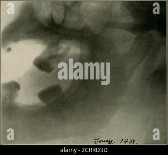 . Radiographie élémentaire et dentaire . Figure 281. Les flèches pointent vers une fracture de la mâchoire inférieure juste derrière le second bicus-pid. Le côté opposé de la même mâchoire a été radiographié sur la Fig. 280. (Radiographie par Cole et Raper.) 244 RADIOGRAPHIE DENTAIRE. Figure Radiographie silencieuse de l'articulation temporo-mandibulaire. Fait mousser. (Radiographie de Tousey, de New York.) Cas: Dislocation de la condyle des Tigs. 283 et 284. fosse des glénoïdes. Figure 283 montre le condyle A antérieur à l'emincntia articularis B. Fig. 284 de ce cas après réduction. Alors qu'il ne montre pas le condyle ses Banque D'Images