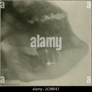 . Radiographie élémentaire et dentaire . Fig. - M.. Figure 247. Fig. 246. Cementoma sur molaire inférieur, deuxième, à couronne de coquille. (Radiographie par ramette, de Chicago.)Fig. 247. Cementoma. (Radiographie par ramette, de Chicago.) d'abord, puis le troisième molaire. Cela a été fait, et la névralgie disappearedpendant environ dix jours, puis la douleur est retournée. Une autre radiographie (Fig. 249) a été fait qui montre un whorl d'os dans la région d'où le secondmolaire avait été enlevé. Une autre opération a été faite en enlevant thewhorl, après quoi la névralgie a complètement disparu. 2l6 RADIOGRAPHIE DENTAIRE. Figure 248. Un tiers mola inférieur non éclaté Banque D'Images