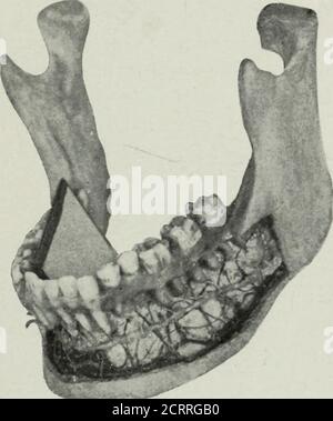 . Radiographie élémentaire et dentaire . d la radiographie faite à partir de cette pose. Les racines c'est parce que le fihn n'a pas été pressé do^vn; assez loin, ou thetube n'était pas assez bas. Les différences sHght dans, thp^po^ses aux makeradiographes des dents antérieures et des troisièmes molaires du poseshown sur la Fig. 91 sont visibles. :, f IJ;; avec le film placé dans la bouche comme sur la Fig. 89,-sauf avec le côté sensible du film se présentant vers le bas au lieu des dents supérieures, et une pose comme indiqué à la Fig. 92, les radiographies des dents inférieures peuvent se brouer. RÉALISATION DE RADIOGRAPHIES DENTAIRES 97 la distance du tube est p Banque D'Images