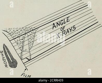 . Radiographie élémentaire et dentaire . Figure 83. La bonne posture pour faire des radiographies de la partie supérieure bicuspide et du reglfm molaire, et la radiographie qui a été faite à partir de cette pose. IIG. 84. Illustration schématique des rayons frappant la dent et le film à un tel angle afin d'éviter d'allonger ou de raccourcir l'ombre moulée sur le film. RÉALISATION DE RADIOGRAPHIES DENTAIRES 93 Banque D'Images