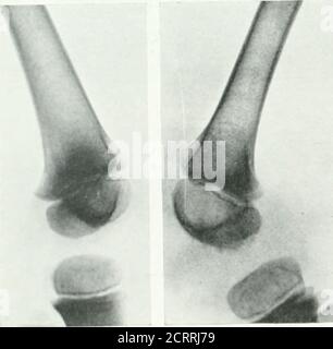 . Archives de la médecine physique et de la réadaptation . ofla patella à l'attaché tendineux de la patella a été observé mtrois de ces cas, il a probablement été le facteur étiologique dans l'arthrite dans ces cas. Les jointmarges irrégulières sont sans aucun doute normales. Dans l'acase de la polyarthrite (?) Le conditionformé dans une articulation du genou a été pensé pour être dû à l'arthrite, mais l'examinationde l'autre genou a révélé qu'il était normal (Fig. I ). Dans un autre cas encore, en raison de cette apparence rugueuse, une ostéomyélite à l'égaage était presque confondue avec une arthrite. L'autre s'agenouillé Banque D'Images