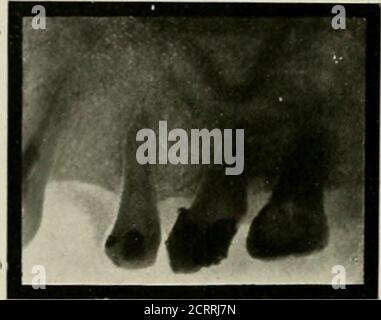 . Radiographie élémentaire et dentaire . l. Dans ce cas, la radiographie a enregistré un travail considérable et s'inquiète de la part de l'opérateur. J'ai le deuxième et le troisième molaires pour avoir seulement un canal, mais c'est le seul casei jamais rencontré dans lequel un premier molaire avait un seul canal. Ce cas était entre les mains de l'un des plus TIG. 167. Opérateurs experts à Indianapolis. La première bicuspide inférieure avait été dévitalisée, et la pulpe retirée, 174 RADIOGRAPHIE DENTAIRE, mais la dent demeurait douloureuse. La radiographie a eu recours pour apprendre, ifpossible, la cause de la péricementite persistante. Un morceau de li Banque D'Images