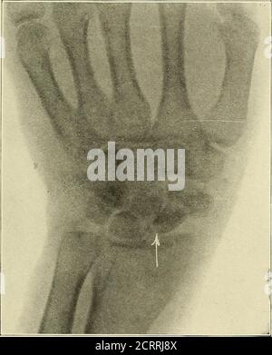 . Electro-thérapeutique pratique et radiothérapie : avec des chapitres sur la photothérapie, la radiographie en chirurgie oculaire, la radiographie en dentisterie, et l'aspect médico-légal de la radiographie . scaphoïde est fracturé à son point central et le point le plus faible. Cette fracture n'était pas reconnue au moment de la blessure, et le thewrist a été traité pour une entorse. Le processus styloïde de l'ulnawas s'est fracturé et a été déplacé en même temps que le scaphoïde a été fracturé. Les fractures du scaphoïde sont très difficiles à reconnaître par examen fluoroscopique, car l'os est généralement brisé obliqueet la ligne de fracture n'est pas clairement visible avec le TH Banque D'Images