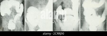 . Archives de médecine physique et de réadaptation . nt où il est traversé par le côlon transverse. Après le dépôt de l'intestin le sigmoïde supérieur est susceptible de montrer un hiatus, soit à partir de la tonicocontraction de l'intestin ou de la prés-sure contre le bord pelvien. Les TumorsOutside the côlon peuvent indenter son contour ; la manipulation déterminera généralement le fait. Si la quantité de l'enema istoo petit il peut se distribuer irregu-lally ; il faut prendre soin que la quantité est adéquate. L'obstruction ne doit pas être assumée à la hâte, car sous les con-ditions normales, l'enema avance souvent à la vitesse ir-régulière et est Banque D'Images