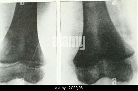 . Archives de la médecine physique et de la réadaptation . ONS examina-^^ tion de l'articulation du genou entre les âges d'environ 4 à 8 ans revealeda le rougissement des surfaces articulaires de l'articulation. Ces examens ont été effectués en relation avec des conditions pathologiques précises, et à plusieurs reprises une erreur de diagnostic a été évitée seulement par une comparaison avec L. R. SANTE, M. D.St. Louis le genou normal. L'écrivain a seenthis condition confondue à plusieurs reprises foran arthrite, et est convaincu qu'il n'est généralement connu que c'est un stade ni-mal dans le développement de theknee jont. Répété Banque D'Images