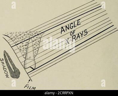 . Radiographie élémentaire et dentaire . Figure 83. La bonne pose pour faire des radiographies de la région bicuspide supérieure et molaire, et la radiographie qui a été faite à partir de cette pose. 34. Illustration schématique de la raya frappant la dent et le film à un tel angle asi» éviter d'allonger ou de raccourcir l'ombre moulée sur le film. RÉALISATION DE RADIOGRAPHIES DENTAIRES 93 ^k C ■ i RV&gt; Fig. 85. Le tube est trop haut et la radiographie résultante. Banque D'Images