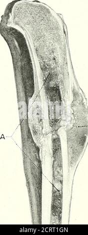 . Sur les méthodes modernes de traitement des fractures . U^l a Banque D'Images